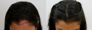 clinicas de injerto capilar en guayaquil International Hair Clinic
